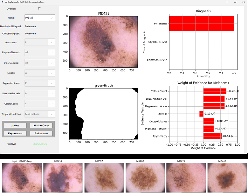 Interface of the Explainable AI Skin Lesion Analyser